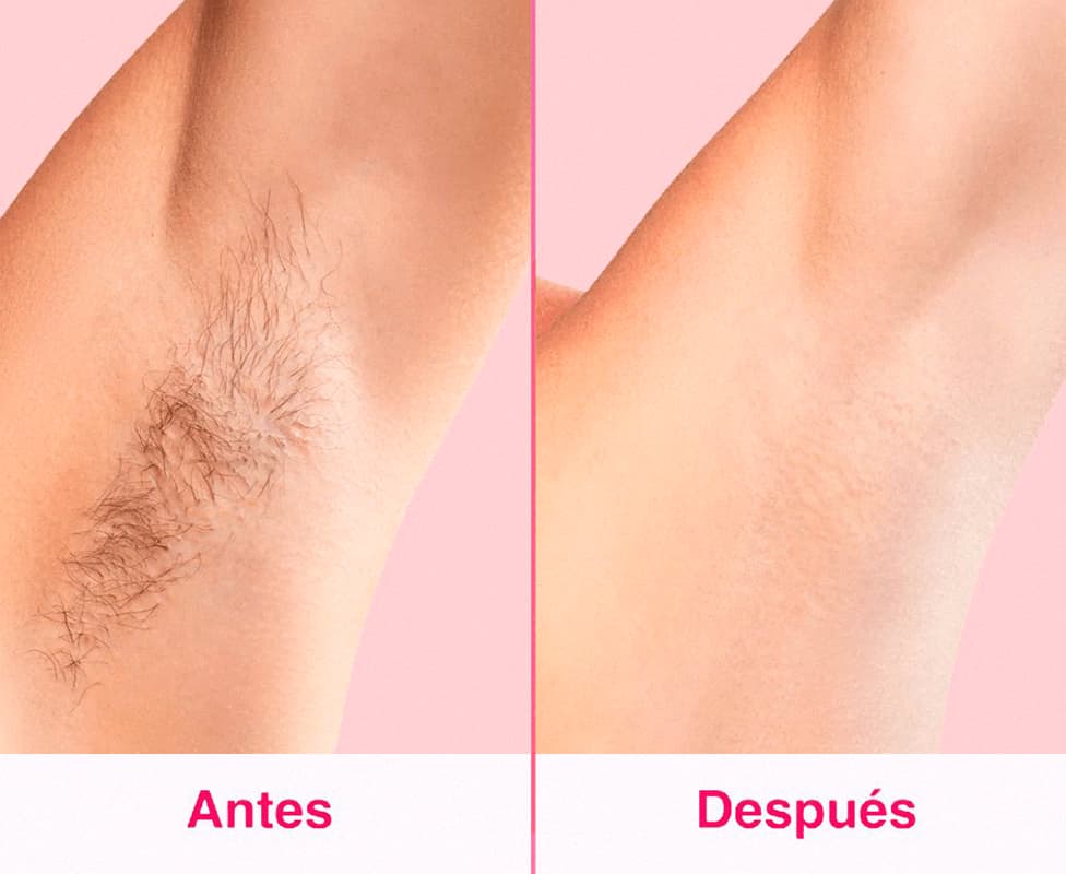 Depiladora Láser IPL - Depilación Permanente en Casa